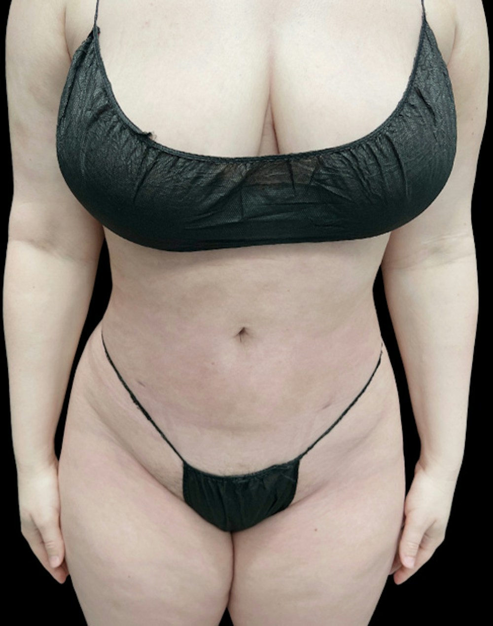 Tight Sculpt with Liposuction Before & After Gallery - Patient 152658 - Image 2
