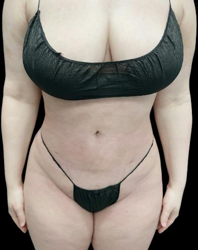 Tight Sculpt with Liposuction Before & After Gallery - Patient 152658 - Image 2