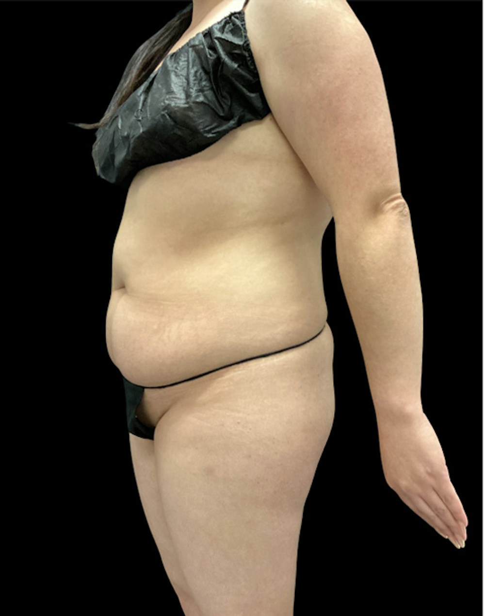 Tight Sculpt with Liposuction Before & After Gallery - Patient 222364 - Image 3