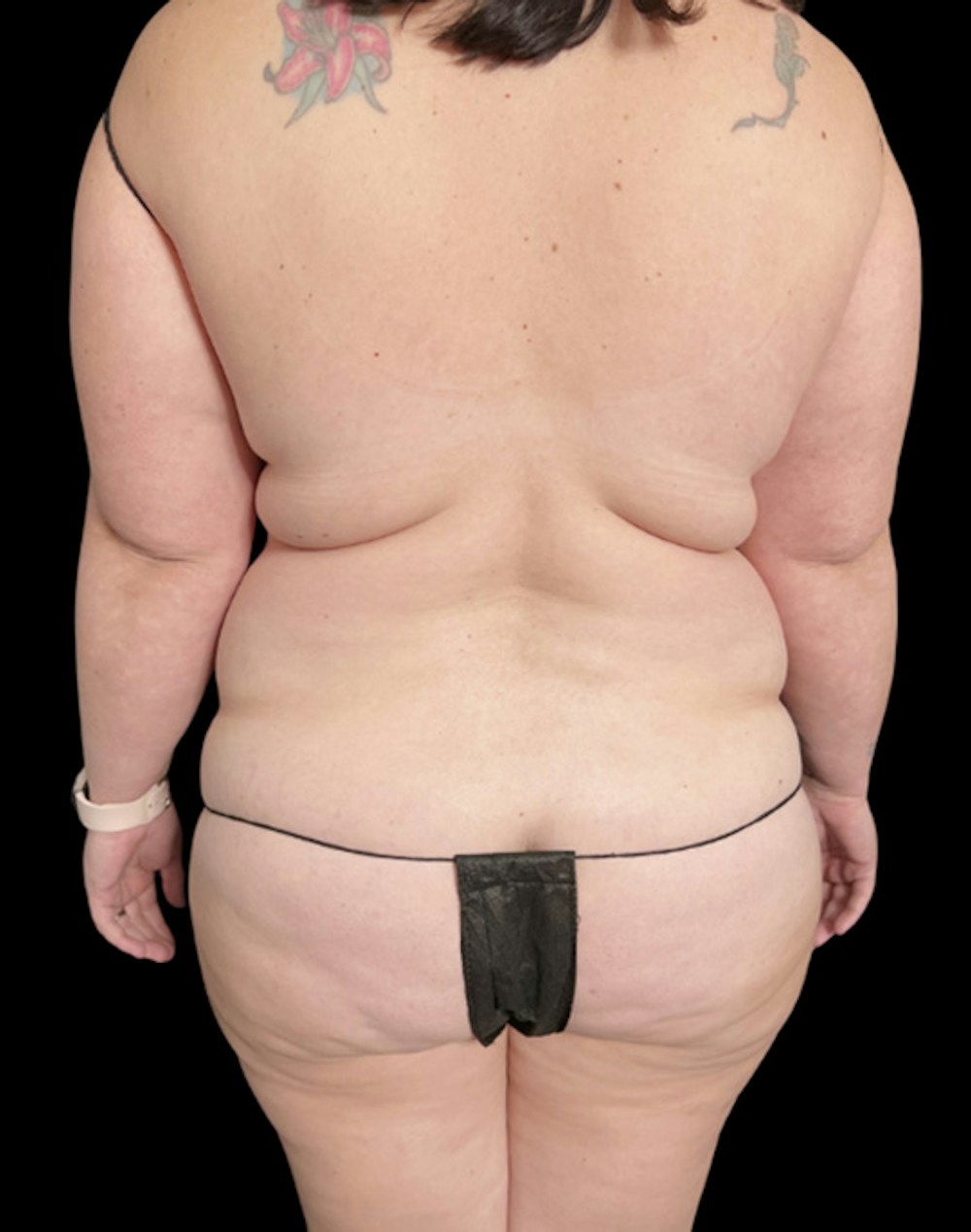 Tight Sculpt with Liposuction Before & After Gallery - Patient 266100 - Image 5