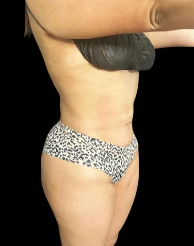 Tight Sculpt with Liposuction Before & After Gallery - Patient 246119 - Image 4