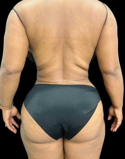 Tight Sculpt with Liposuction Before & After Gallery - Patient 105337 - Image 6
