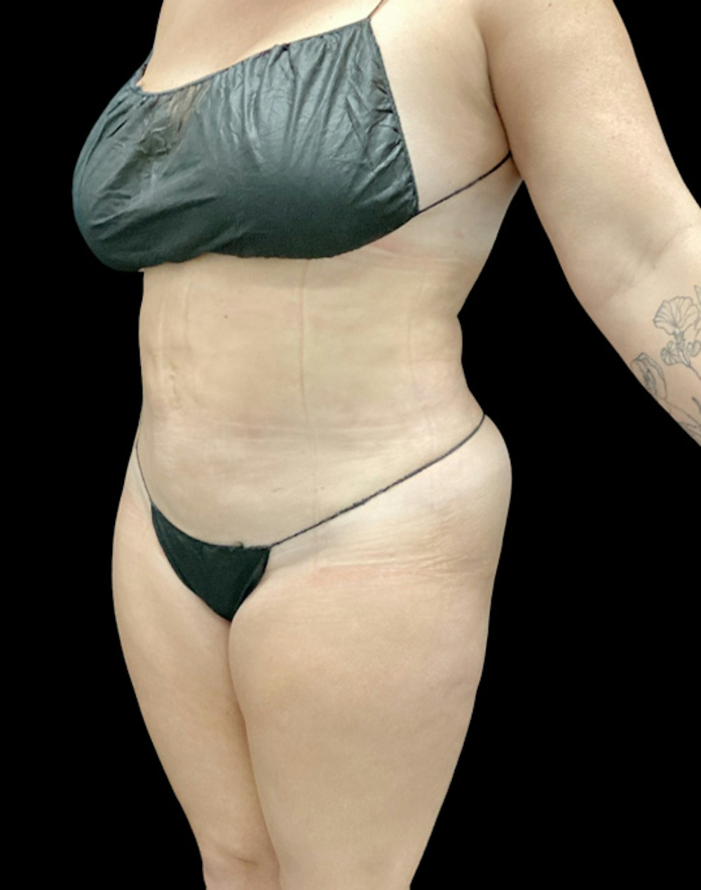 Tight Sculpt with Liposuction Before & After Gallery - Patient 380924 - Image 4