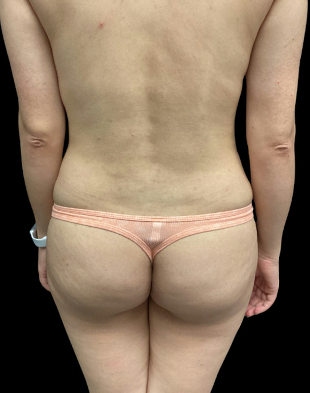 Tight Sculpt with Liposuction Before & After Gallery - Patient 394664 - Image 5