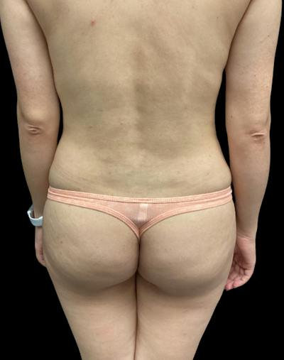 Tight Sculpt with Liposuction Before & After Gallery - Patient 394664 - Image 5