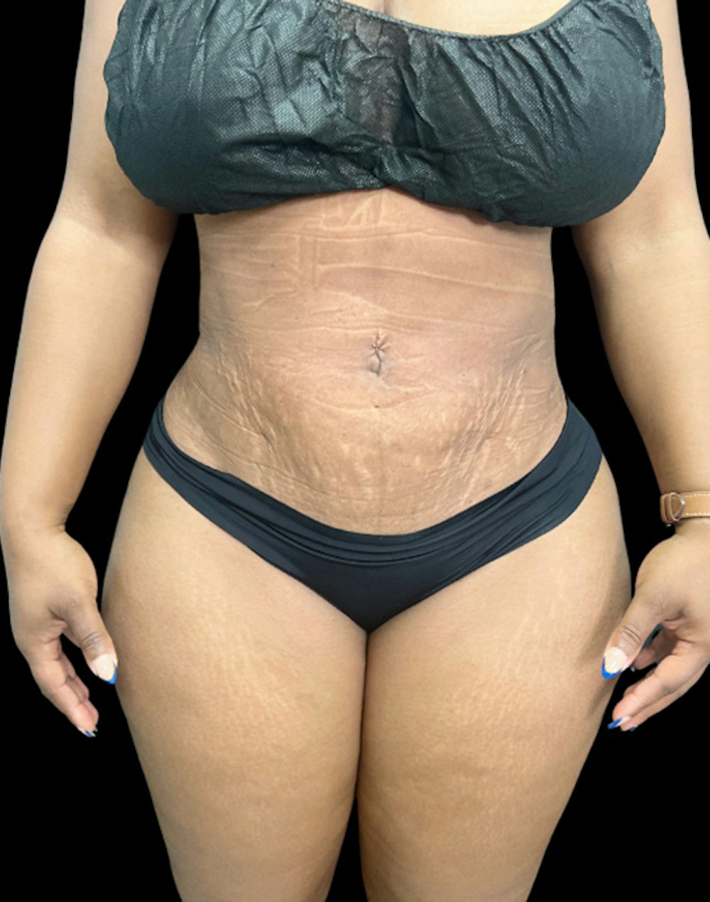 Tight Sculpt with Liposuction Before & After Gallery - Patient 105337 - Image 2