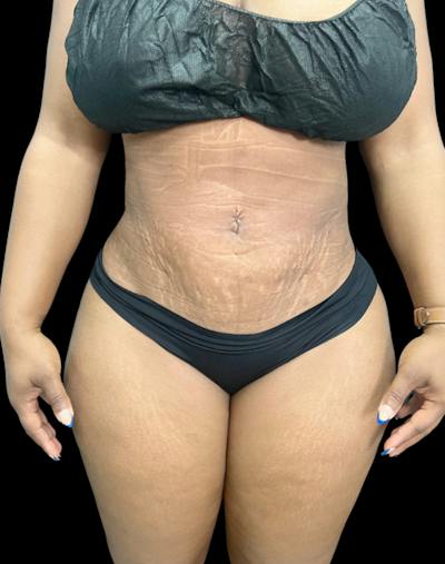 Tight Sculpt with Liposuction Before & After Gallery - Patient 105337 - Image 2