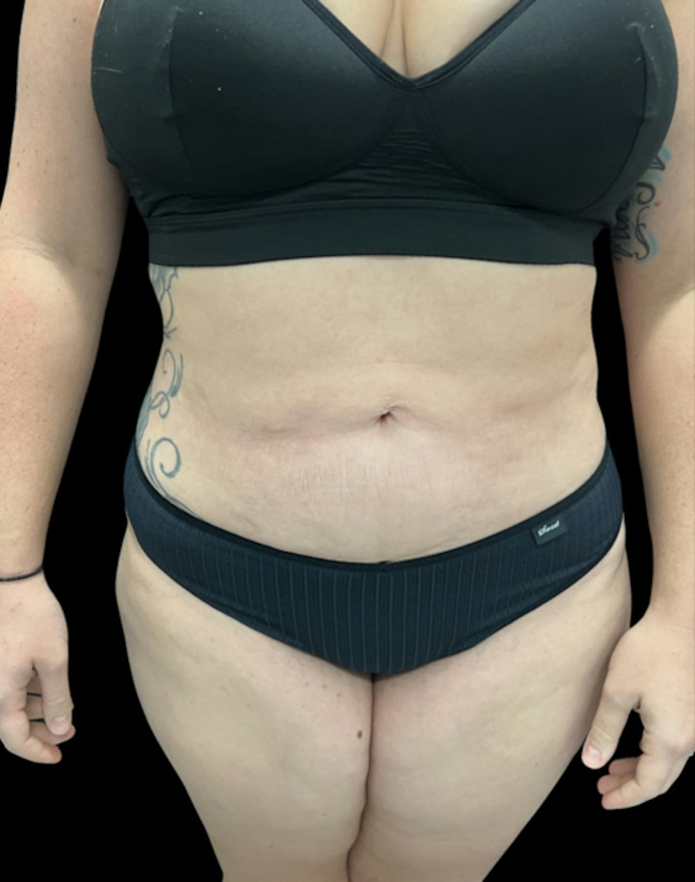 Tight Sculpt with Liposuction Before & After Gallery - Patient 818974 - Image 2