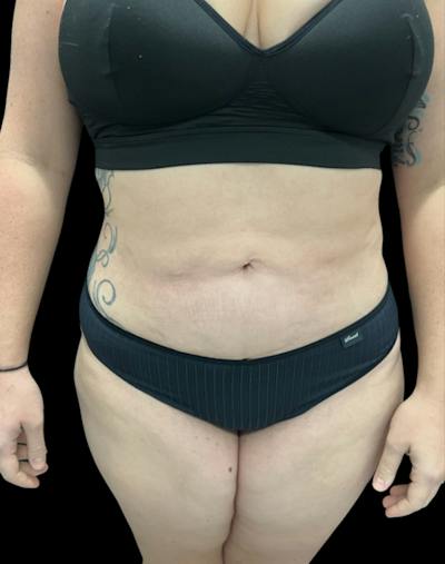 Tight Sculpt with Liposuction Before & After Gallery - Patient 818974 - Image 2