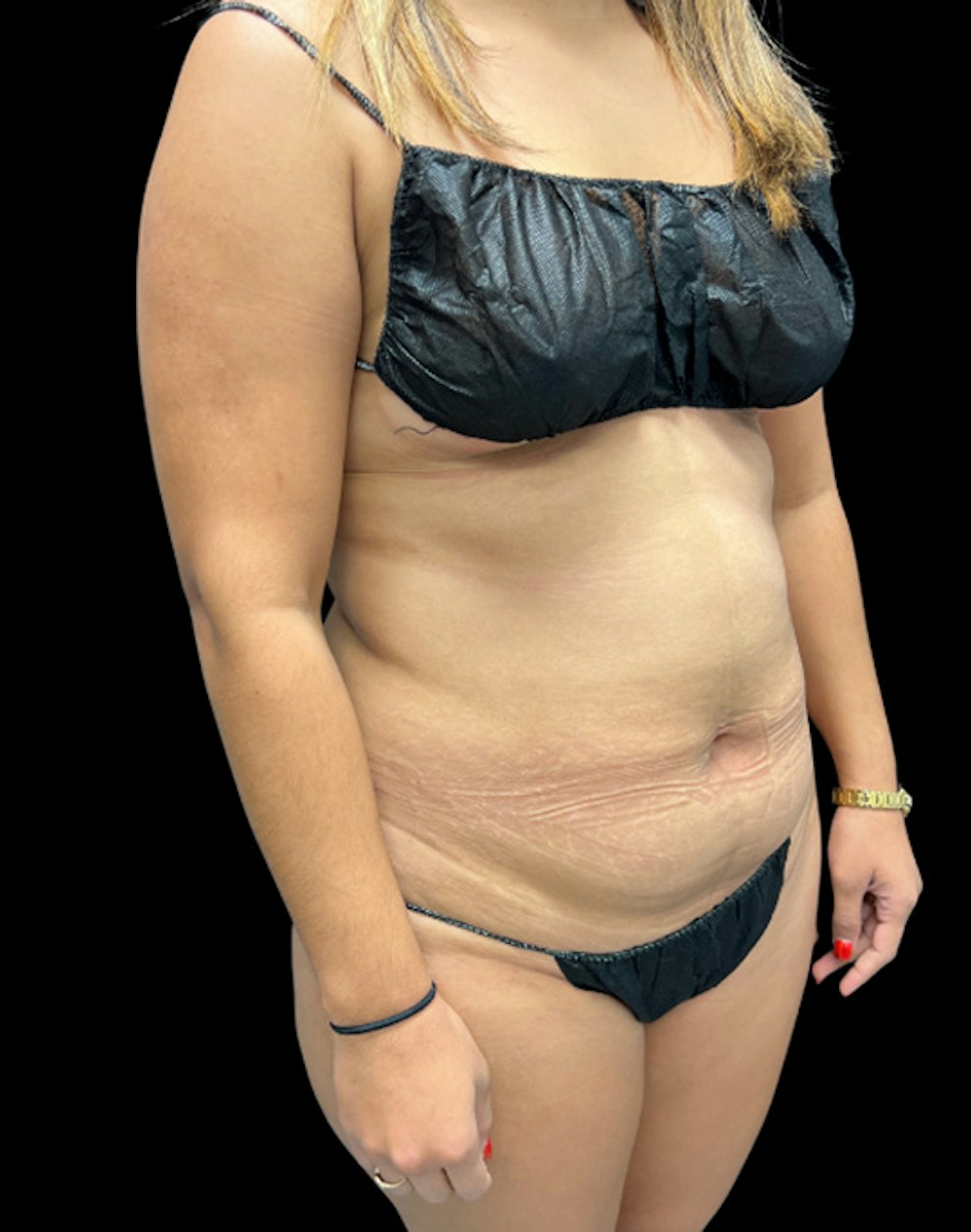 Tight Sculpt with Liposuction Before & After Gallery - Patient 488589 - Image 3