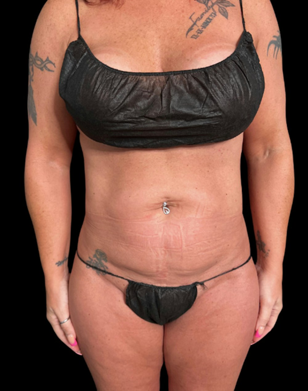 Tight Sculpt with Liposuction Before & After Gallery - Patient 374495 - Image 1