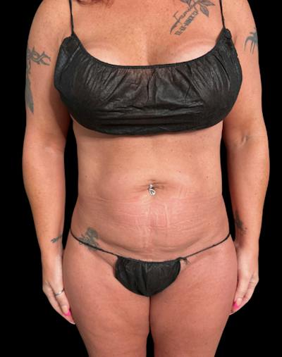 Tight Sculpt with Liposuction Before & After Gallery - Patient 374495 - Image 1