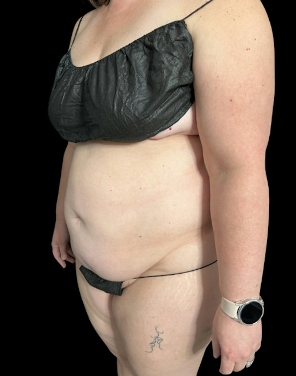 Tight Sculpt with Liposuction Before & After Gallery - Patient 266100 - Image 3
