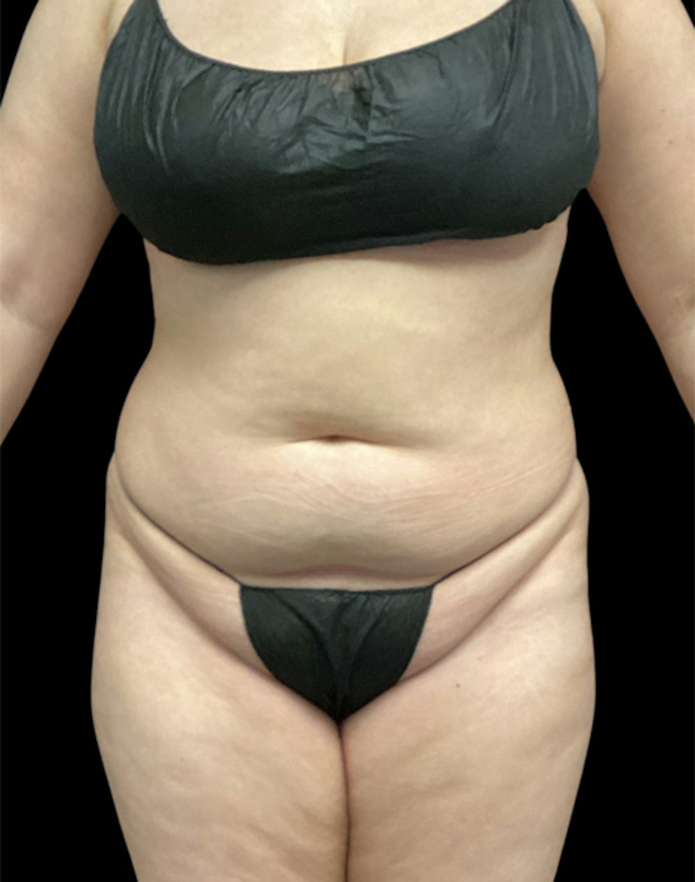 Tight Sculpt with Liposuction Before & After Gallery - Patient 152658 - Image 1