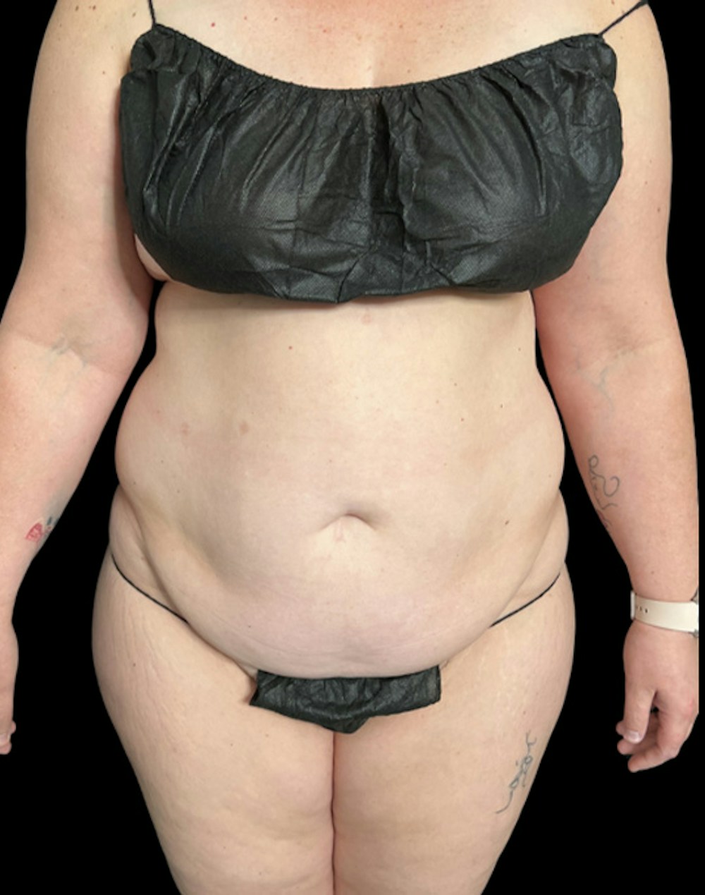 Tight Sculpt with Liposuction Before & After Gallery - Patient 266100 - Image 1