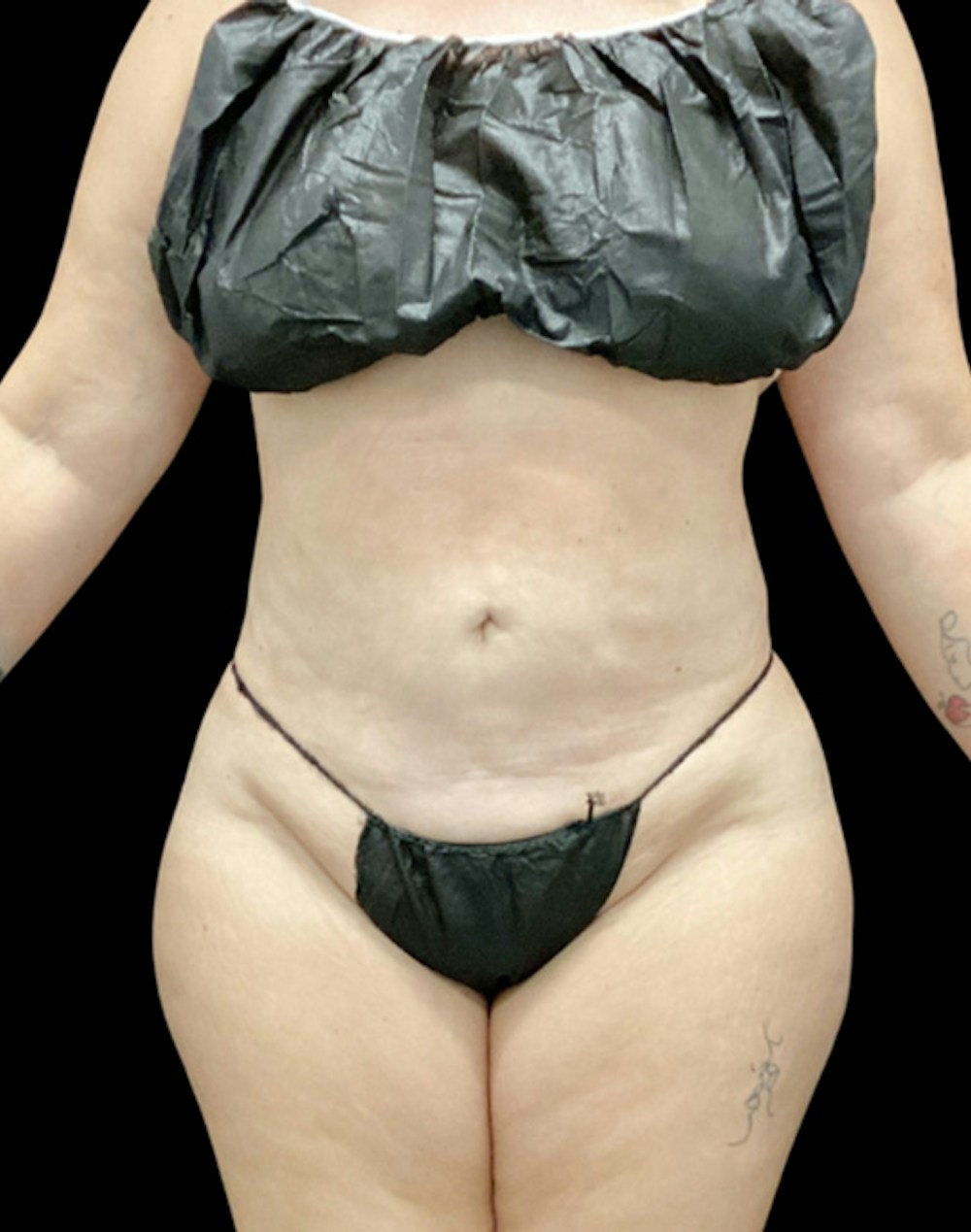 Tight Sculpt with Liposuction Before & After Gallery - Patient 266100 - Image 2