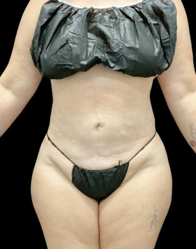 Tight Sculpt with Liposuction Before & After Gallery - Patient 266100 - Image 2
