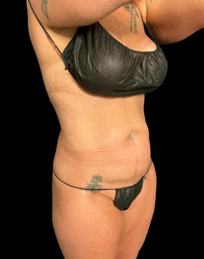 Tight Sculpt with Liposuction Before & After Gallery - Patient 374495 - Image 3
