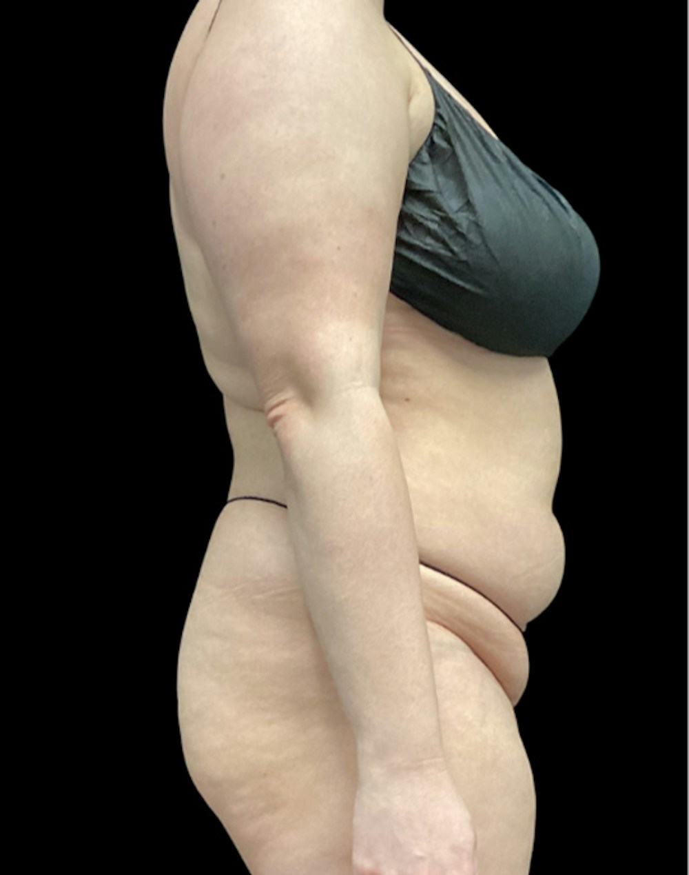 Tight Sculpt with Liposuction Before & After Gallery - Patient 152658 - Image 5