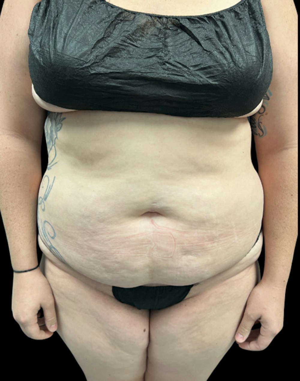 Tight Sculpt with Liposuction Before & After Gallery - Patient 818974 - Image 1