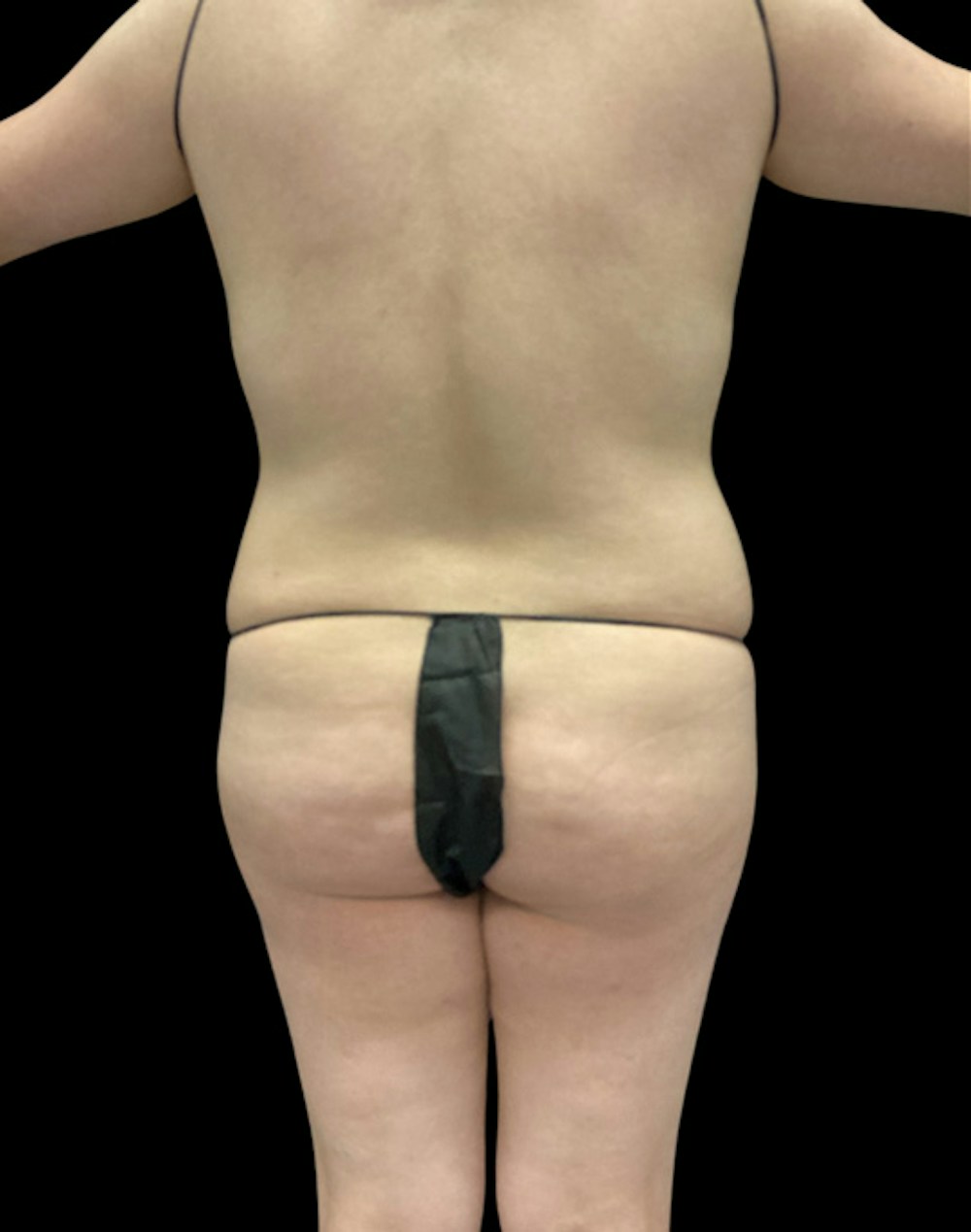 Tight Sculpt with Liposuction Before & After Gallery - Patient 222364 - Image 5