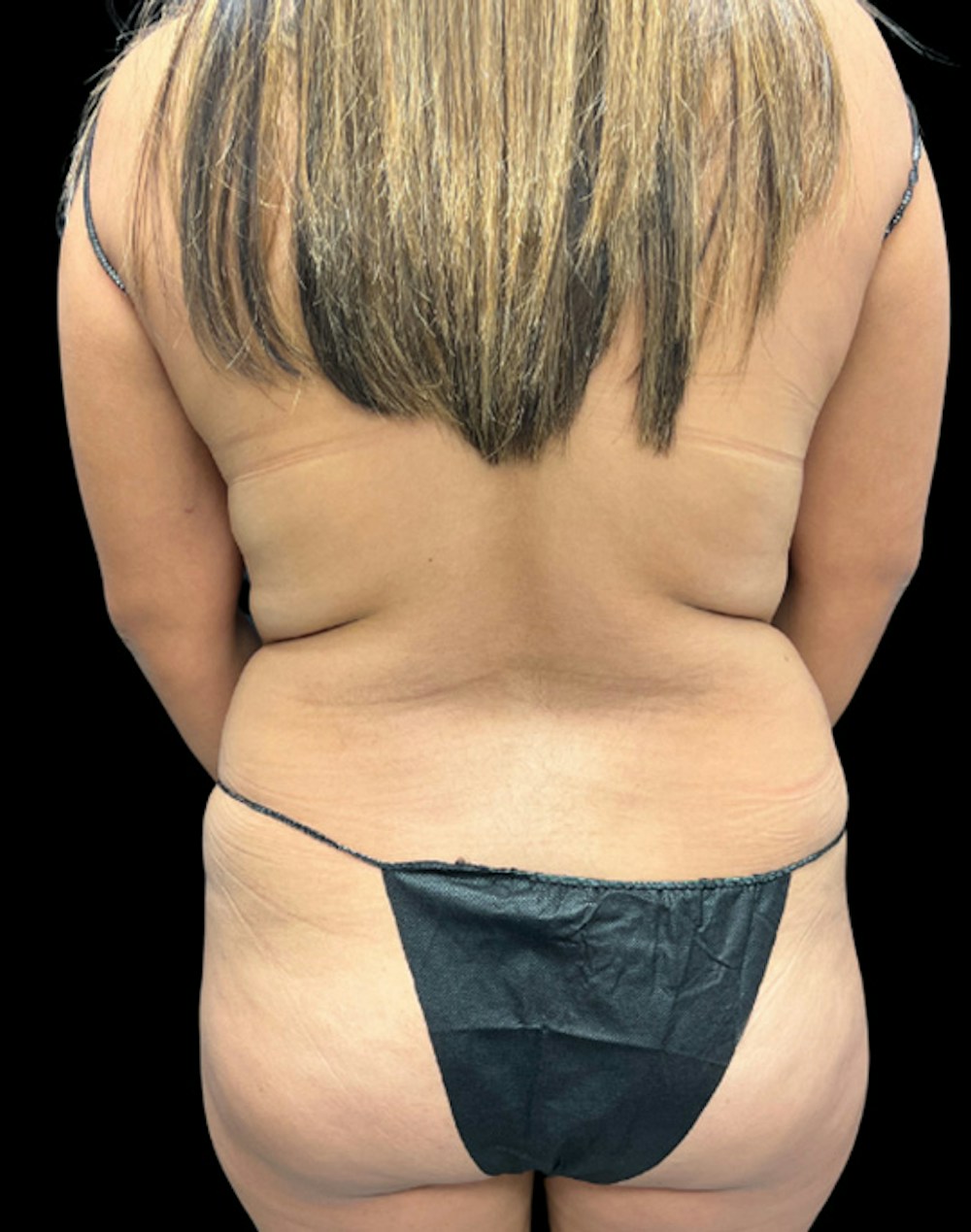 Tight Sculpt with Liposuction Before & After Gallery - Patient 488589 - Image 7