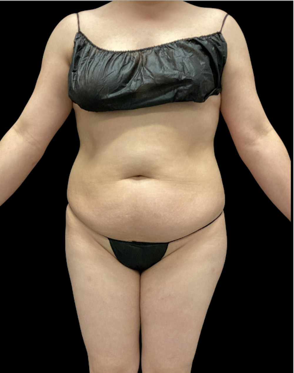 Tight Sculpt with Liposuction Before & After Gallery - Patient 222364 - Image 1