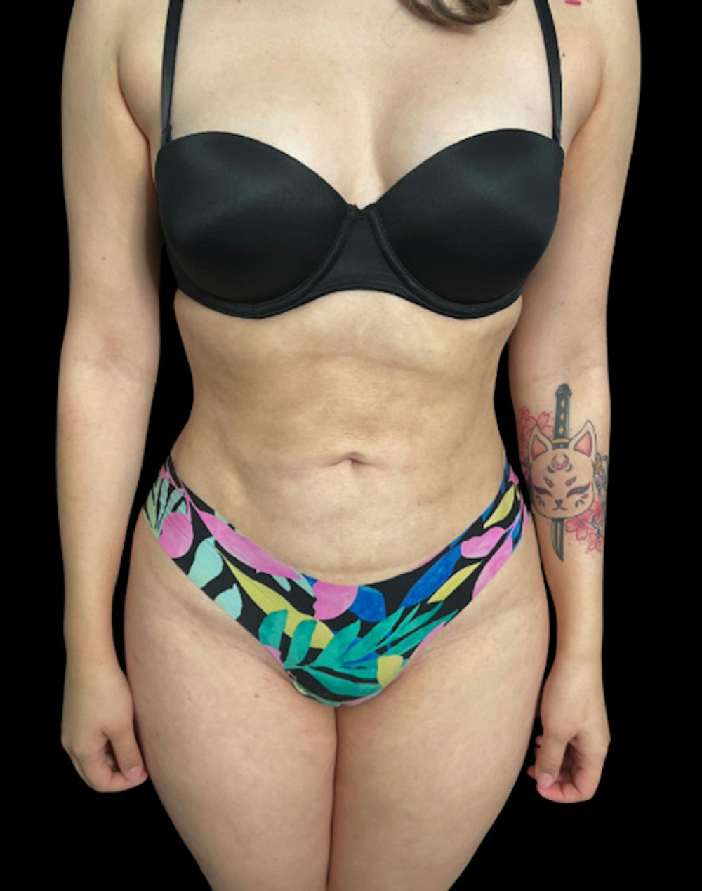 Tight Sculpt with Liposuction Before & After Gallery - Patient 394664 - Image 2