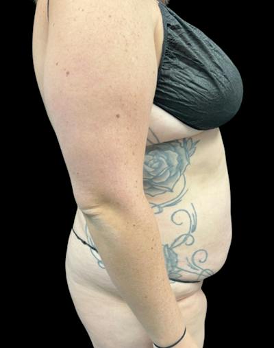 Tight Sculpt with Liposuction Before & After Gallery - Patient 818974 - Image 5