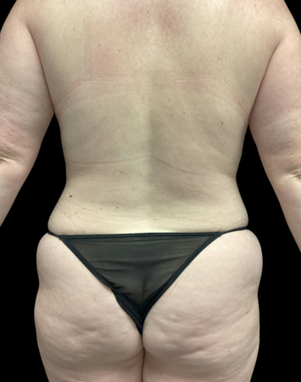 Tight Sculpt with Liposuction Before & After Gallery - Patient 721222 - Image 11