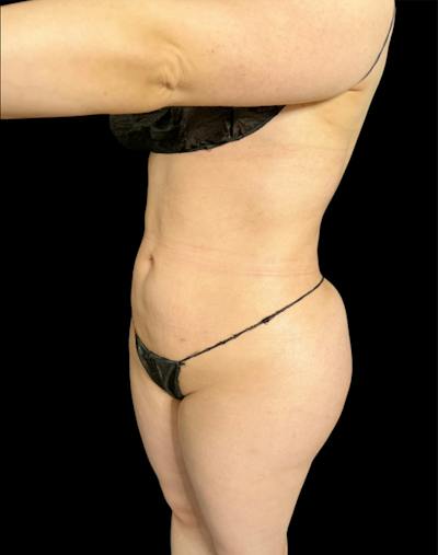 Tight Sculpt with Liposuction Before & After Gallery - Patient 222364 - Image 4
