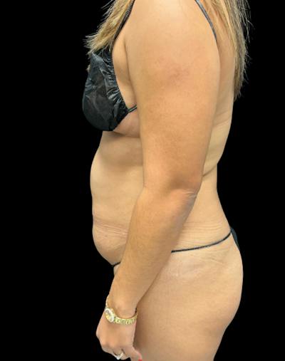 Tight Sculpt with Liposuction Before & After Gallery - Patient 488589 - Image 5