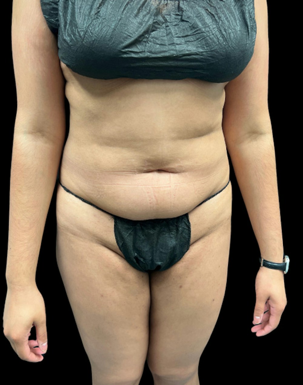 Tight Sculpt with Liposuction Before & After Gallery - Patient 246119 - Image 1