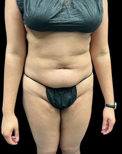 Tight Sculpt with Liposuction Before & After Gallery - Patient 246119 - Image 1