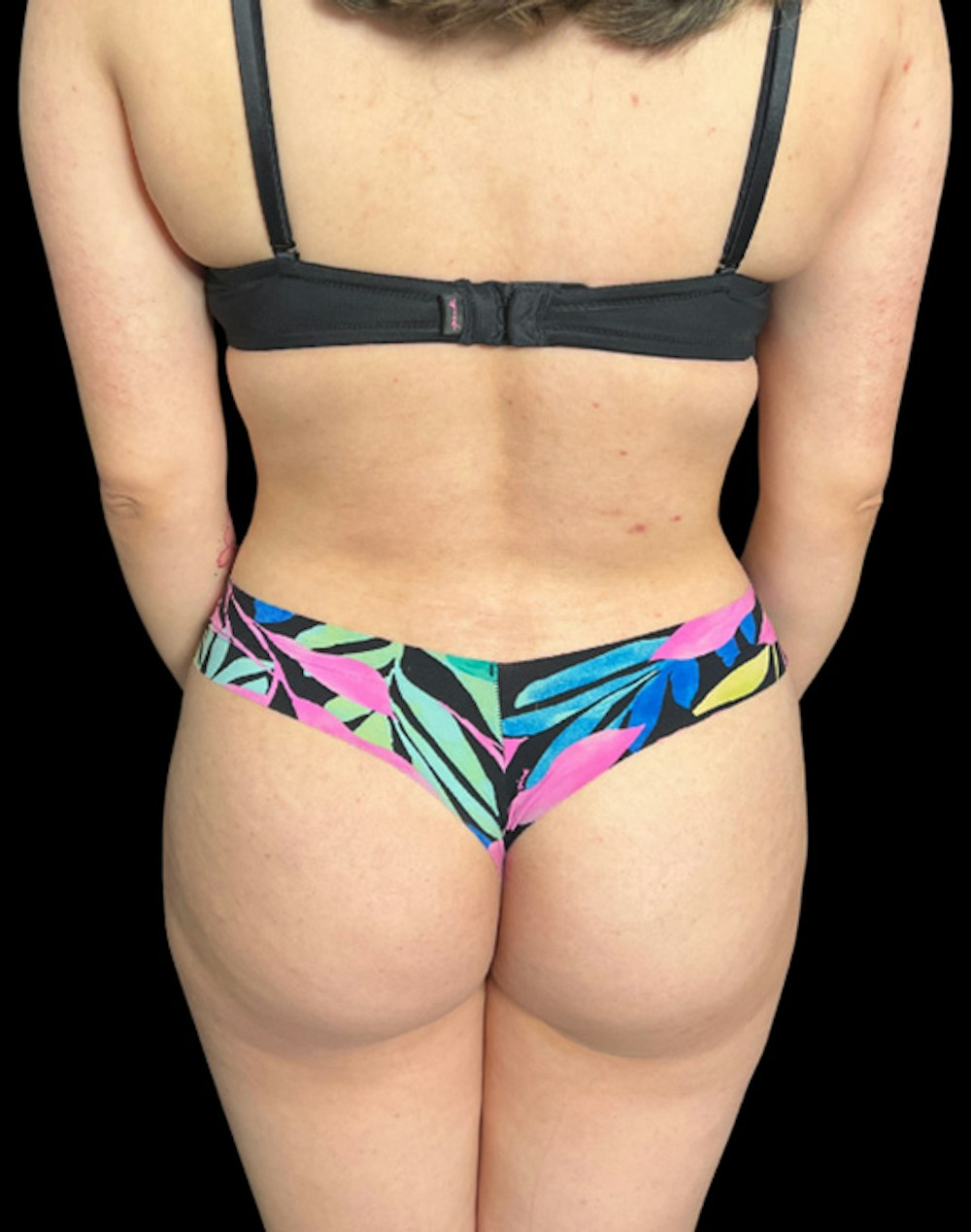 Tight Sculpt with Liposuction Before & After Gallery - Patient 394664 - Image 6