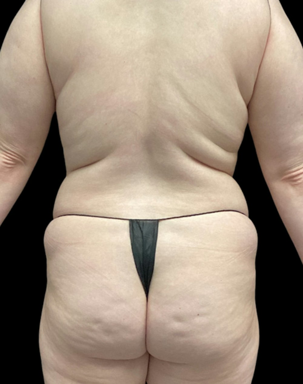 Tight Sculpt with Liposuction Before & After Gallery - Patient 152658 - Image 7