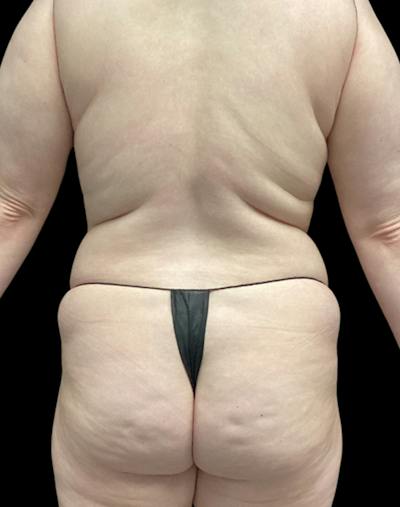 Tight Sculpt with Liposuction Before & After Gallery - Patient 152658 - Image 7
