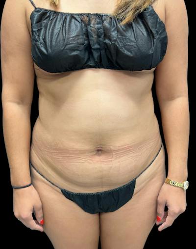 Tight Sculpt with Liposuction Before & After Gallery - Patient 488589 - Image 1