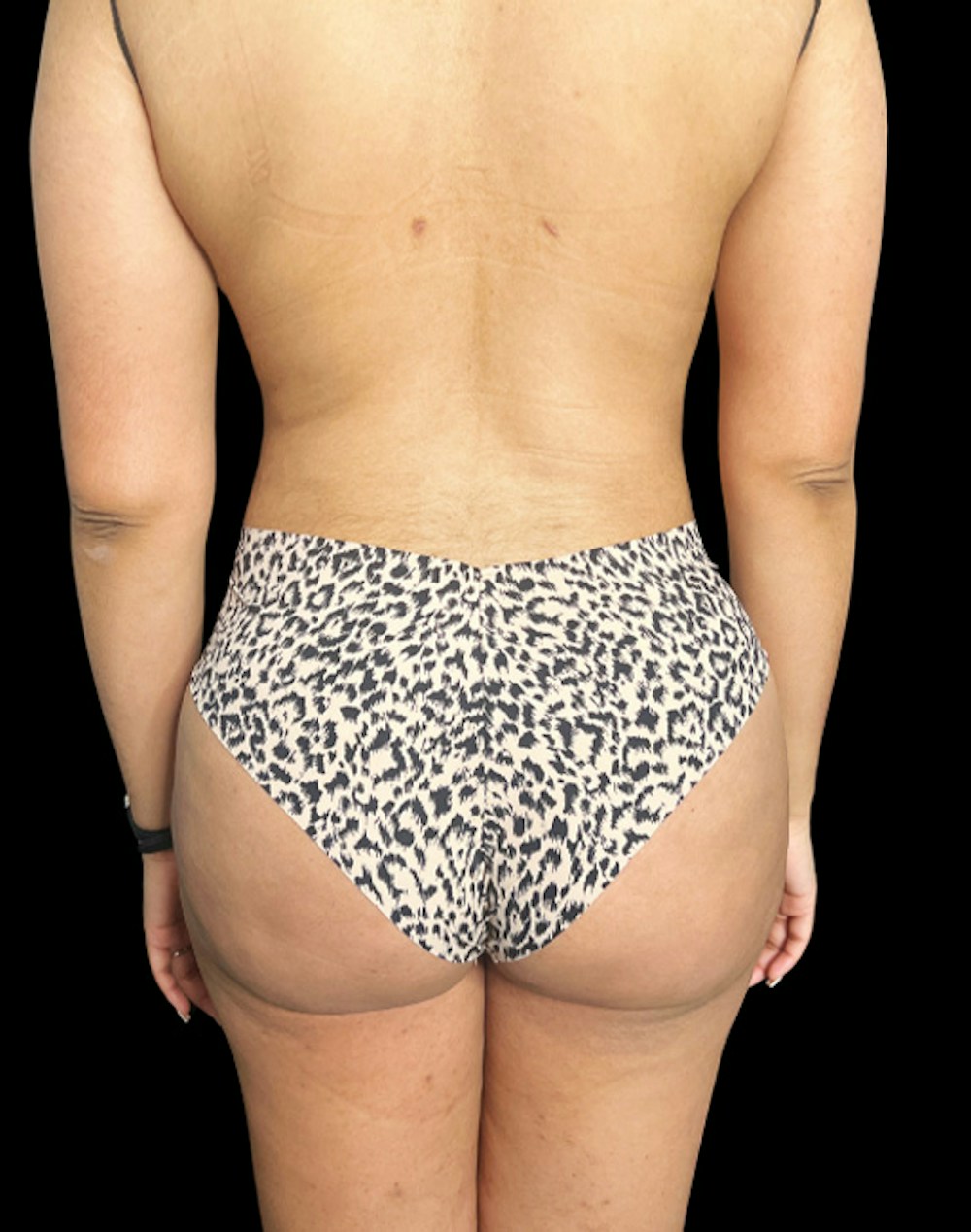 Tight Sculpt with Liposuction Before & After Gallery - Patient 246119 - Image 6