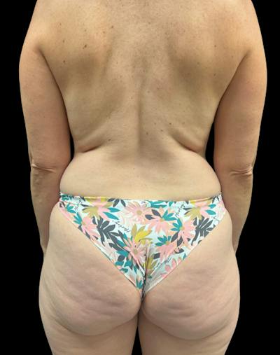 Tight Sculpt with Liposuction Before & After Gallery - Patient 154263 - Image 3