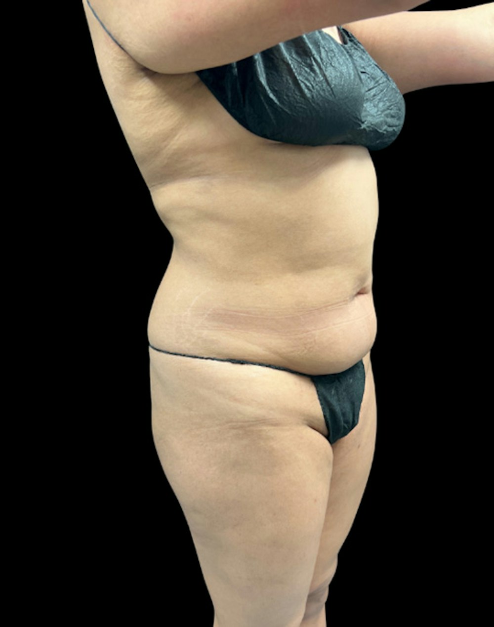 Tight Sculpt with Liposuction Before & After Gallery - Patient 246119 - Image 3