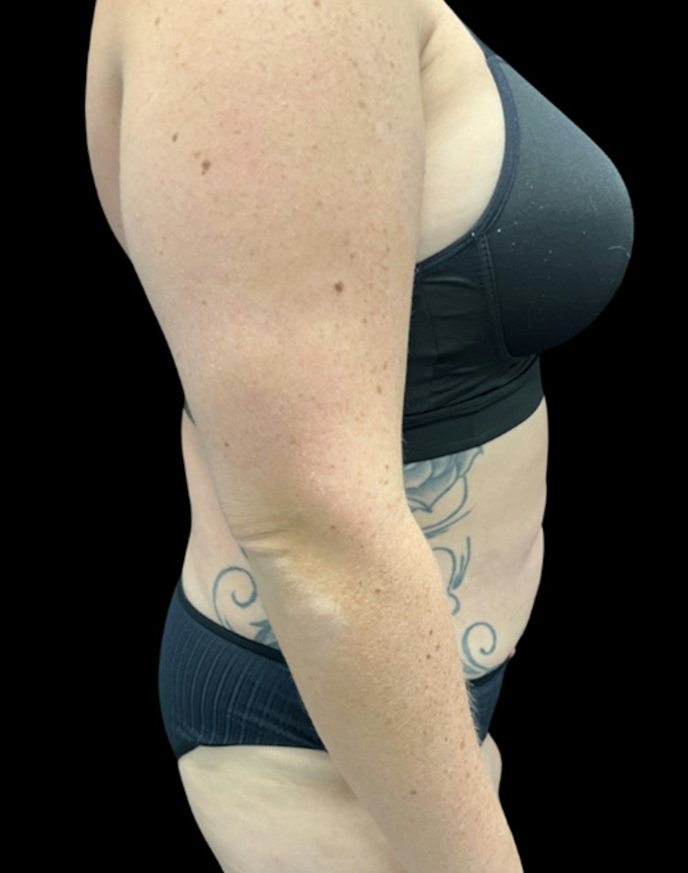 Tight Sculpt with Liposuction Before & After Gallery - Patient 818974 - Image 6