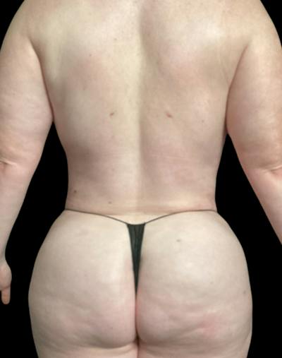 Tight Sculpt with Liposuction Before & After Gallery - Patient 721222 - Image 12