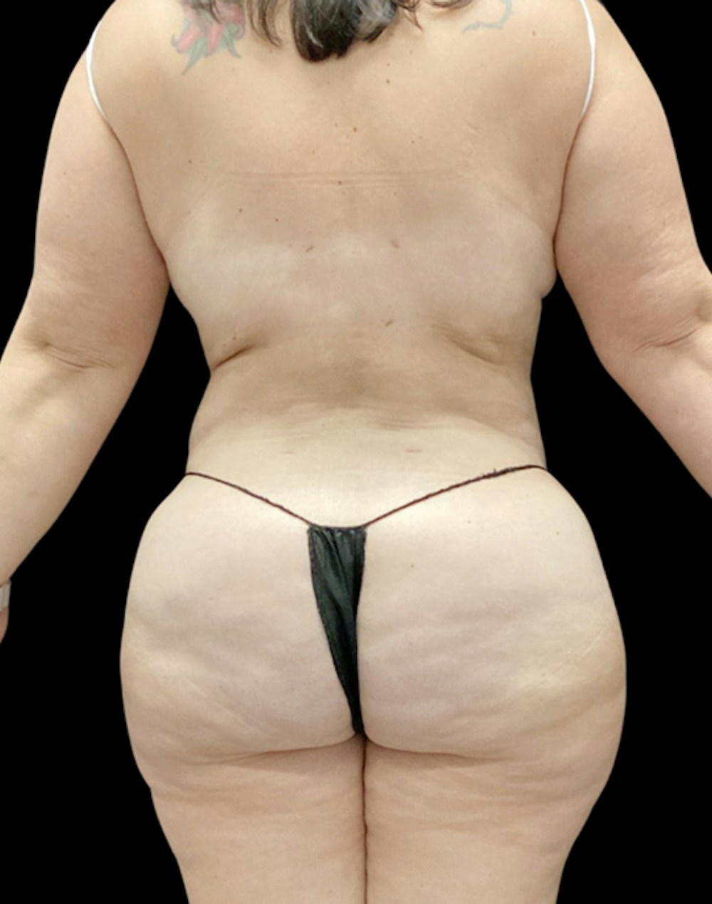 Tight Sculpt with Liposuction Before & After Gallery - Patient 266100 - Image 6