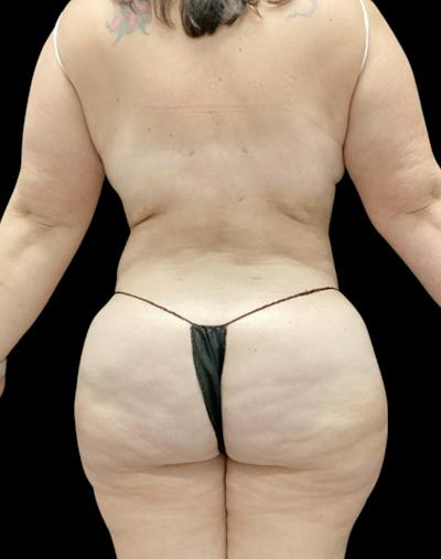 Tight Sculpt with Liposuction Before & After Gallery - Patient 266100 - Image 6