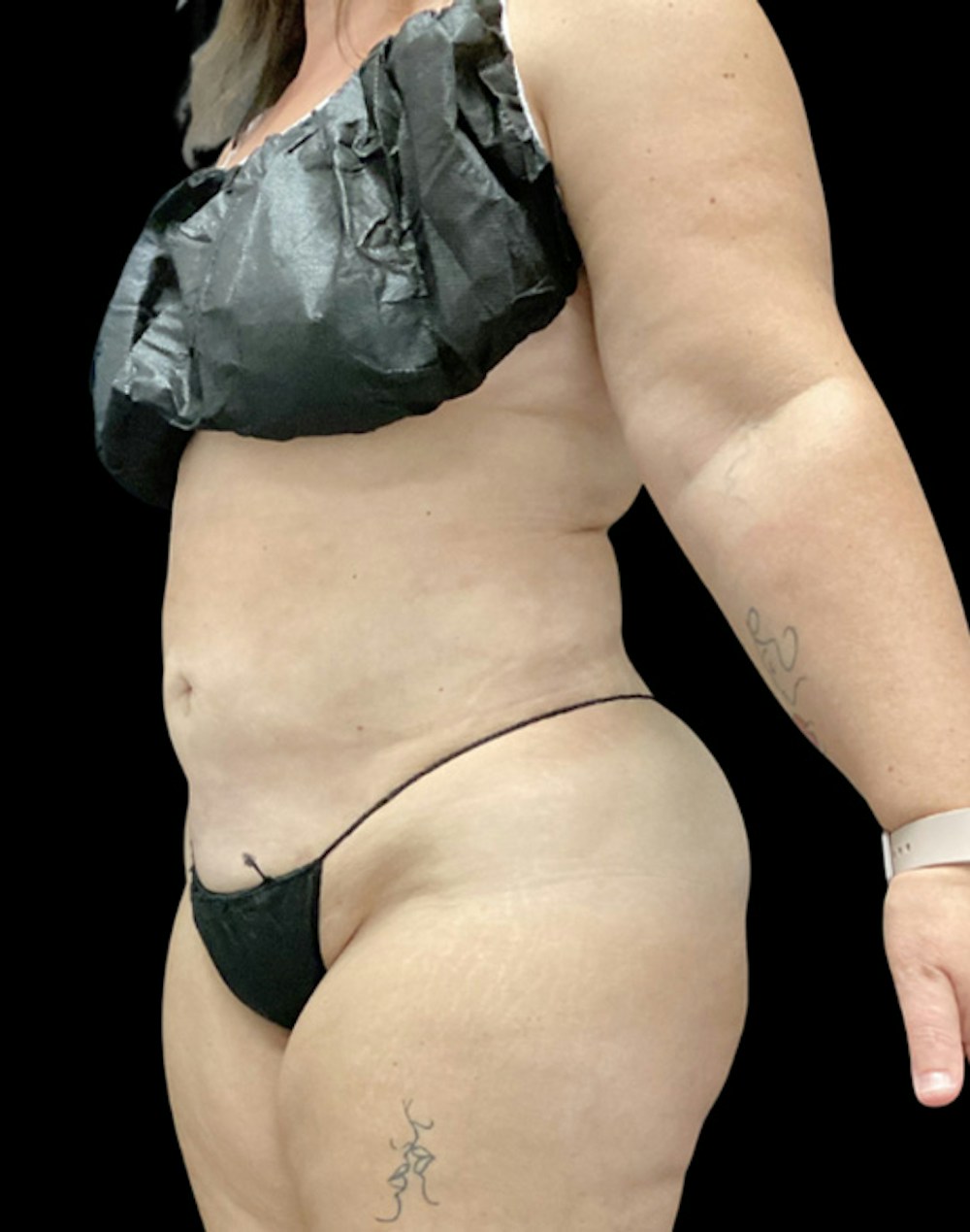 Tight Sculpt with Liposuction Before & After Gallery - Patient 266100 - Image 4