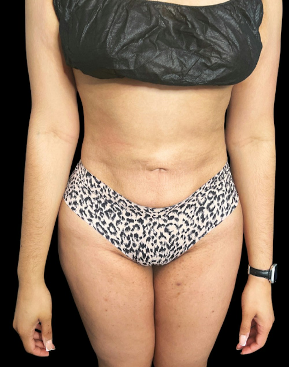 Tight Sculpt with Liposuction Before & After Gallery - Patient 246119 - Image 2