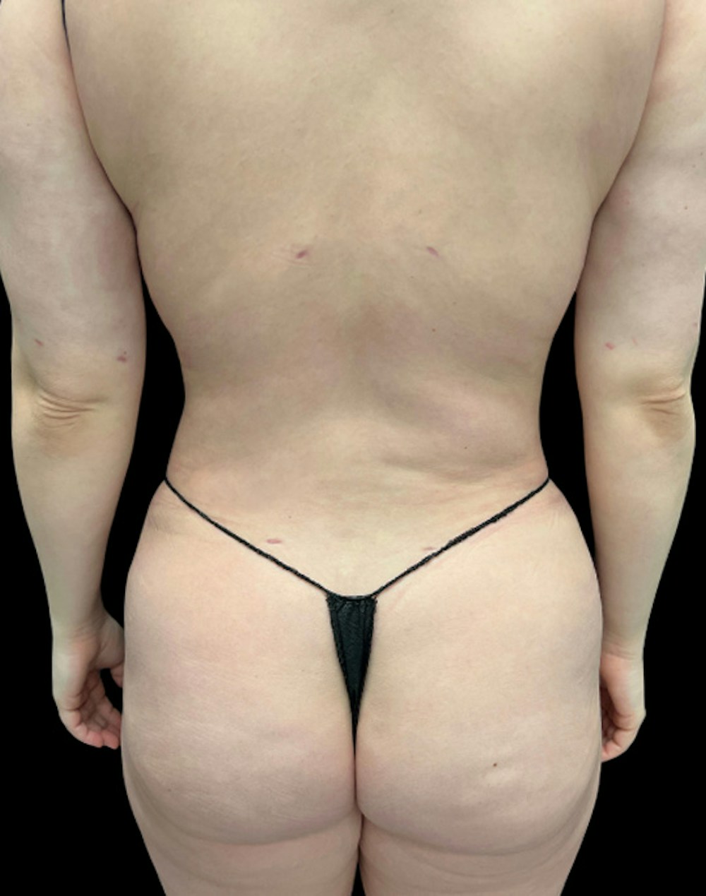 Tight Sculpt with Liposuction Before & After Gallery - Patient 152658 - Image 8