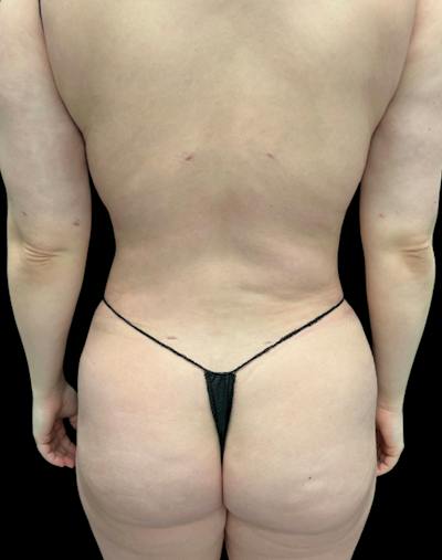 Tight Sculpt with Liposuction Before & After Gallery - Patient 152658 - Image 8