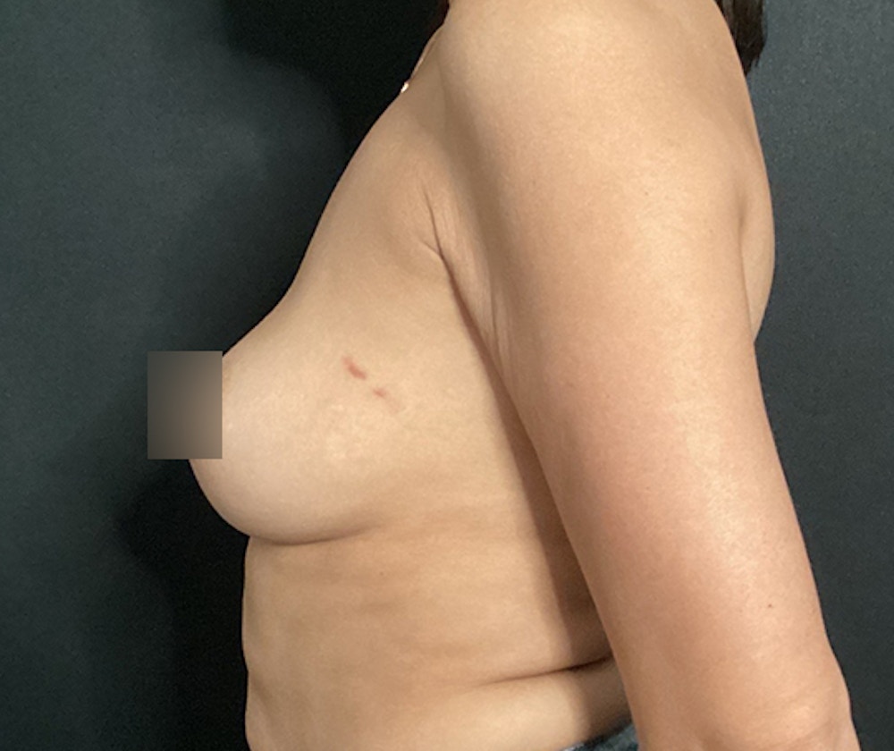 Breast Augmentation Before & After Gallery - Patient 255714 - Image 5